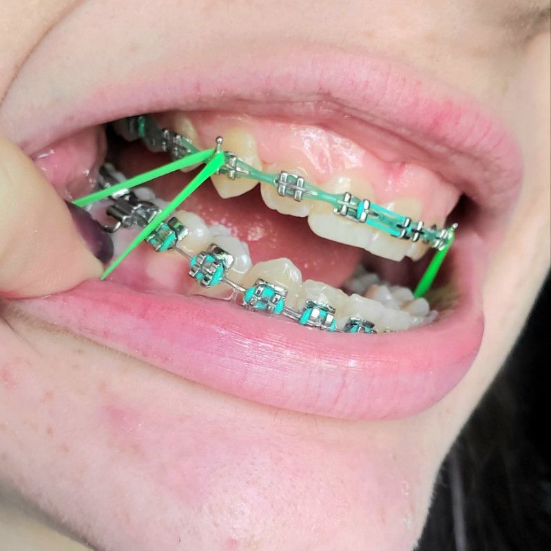 Full Set Of Braces Photoset