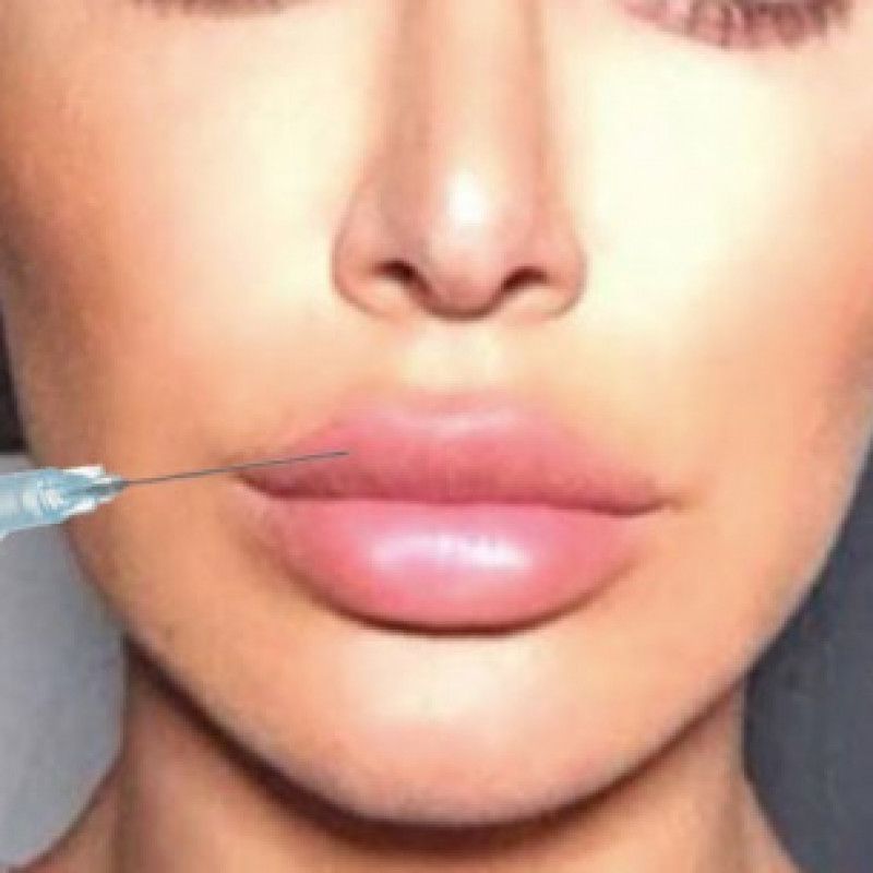 Lip Injections