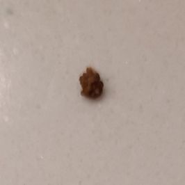 Kidney Stone