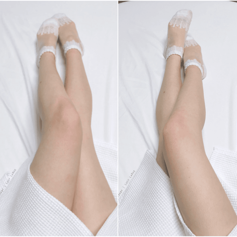 Laser Hair Removal Treatments