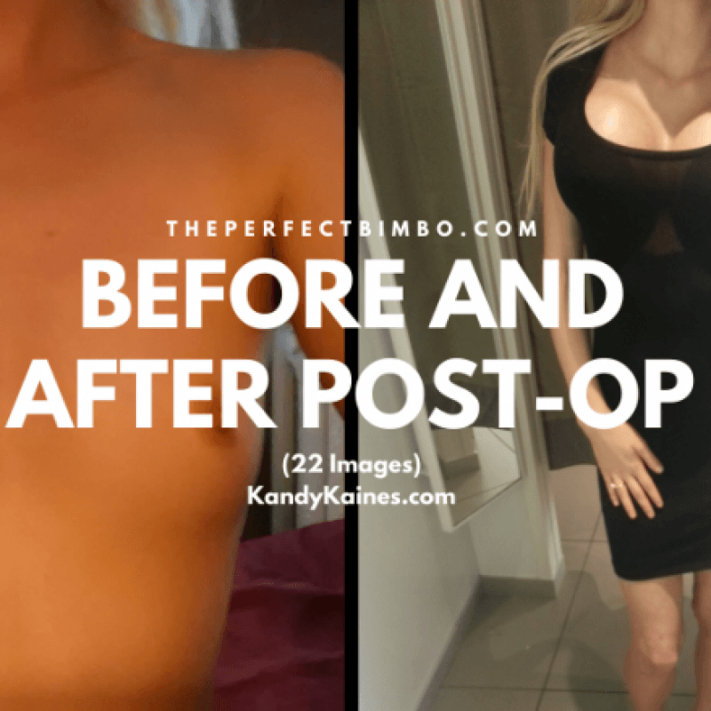 Before And After PostOp