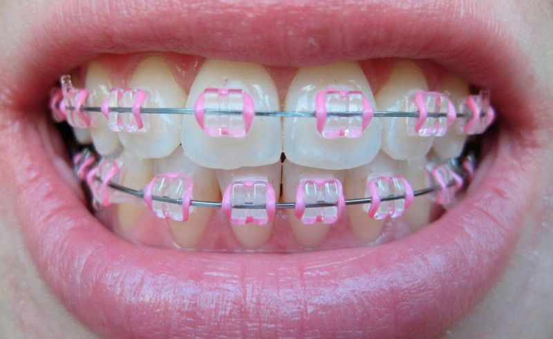 Braces for perfect smile!