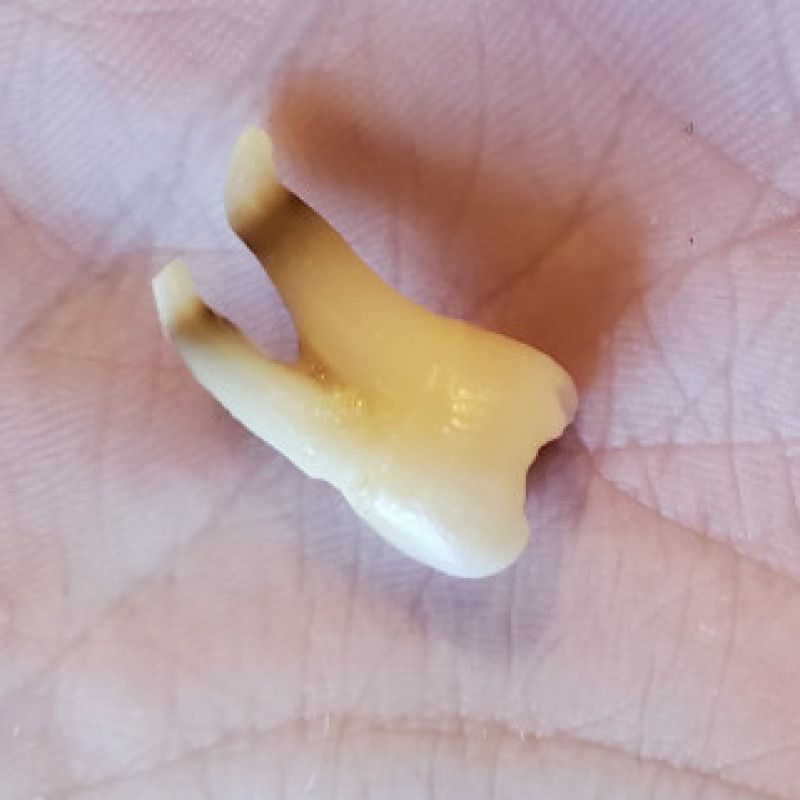 Wisdom Tooth