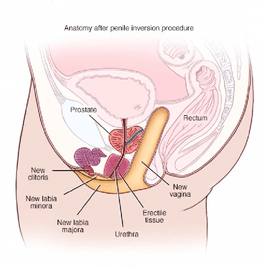 Gender Reassignment Surgery Fund Donation