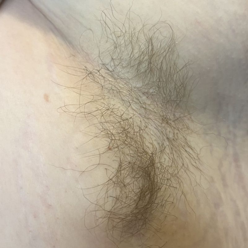 Body Hair