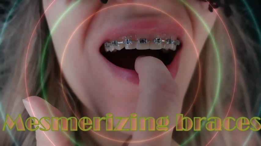 Mesmerizing braces