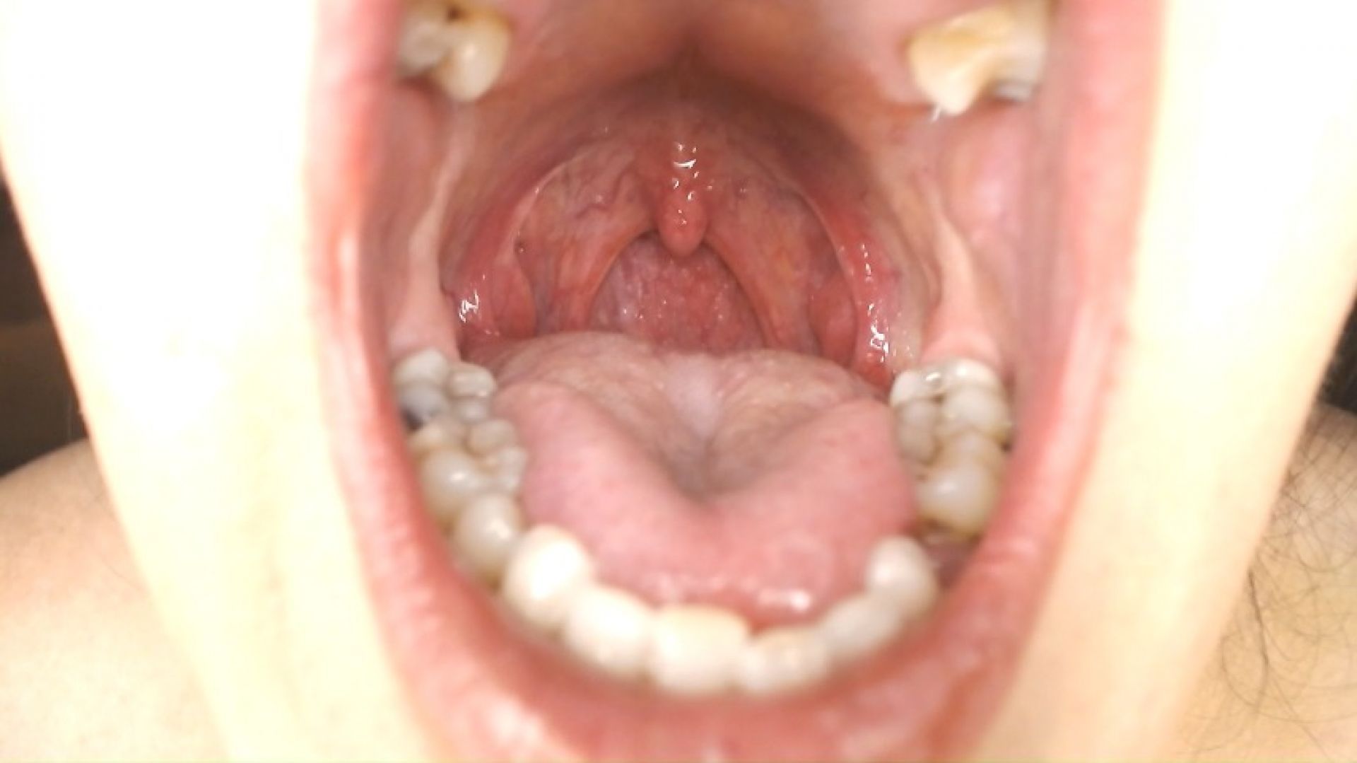 Throat and Mouth Spit Strings Uvula Tonsils Uvula