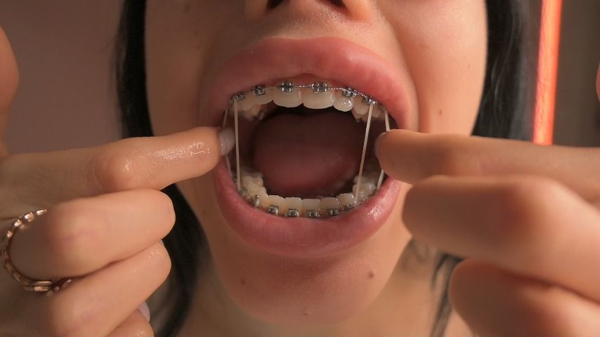 Sweet girl plays with her braces