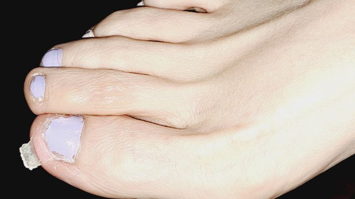 Peeling A HUGE Toe Skin Flake