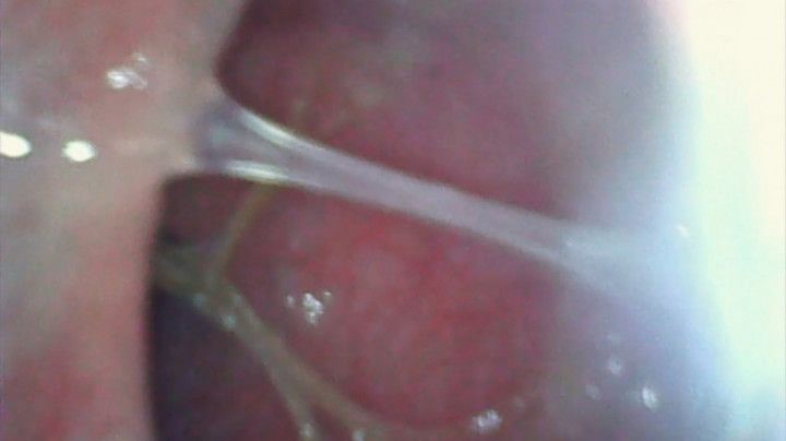 Endoscope Peehole Play