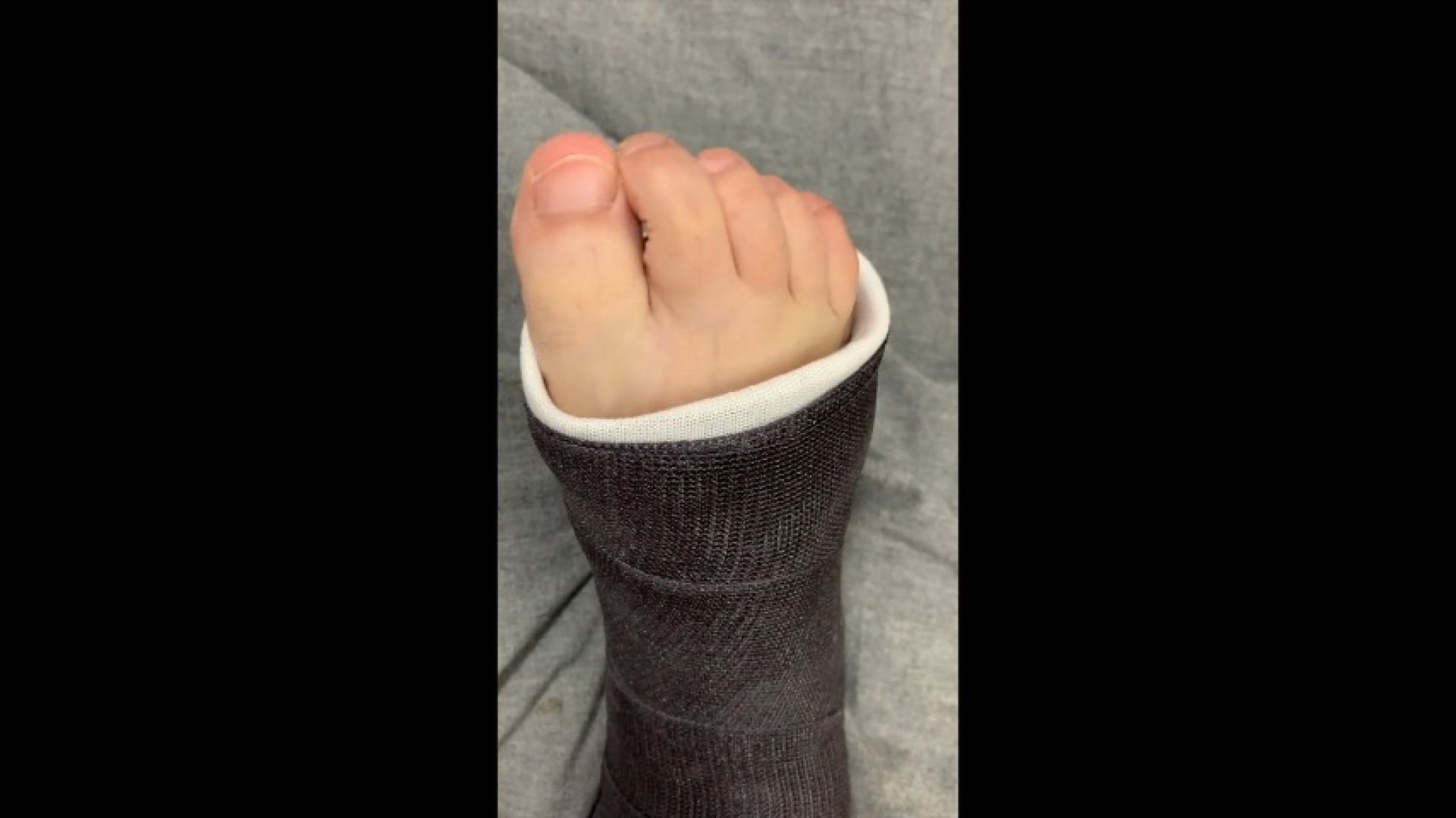 Close Up Toe Wiggling in Short Leg Cast