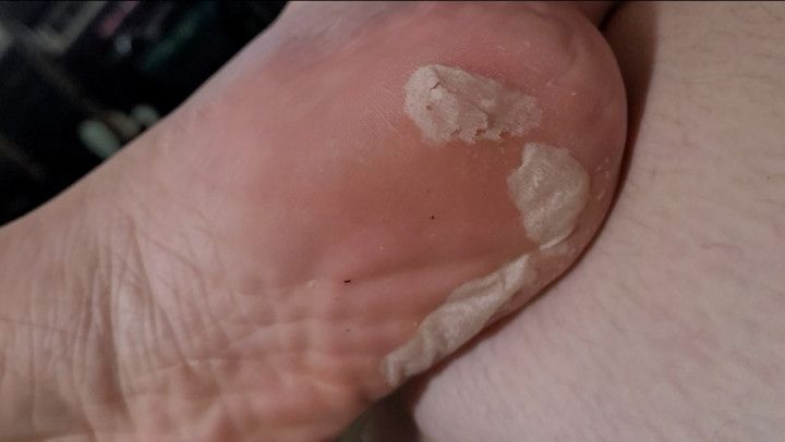 Fat Foot Peel