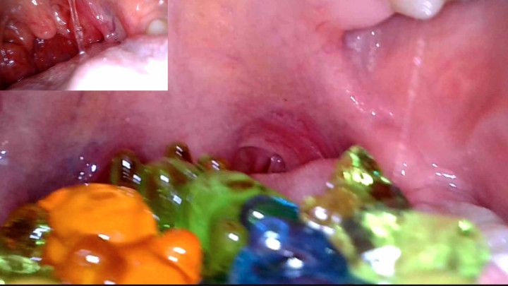 Vore Gummy bears endoscopy