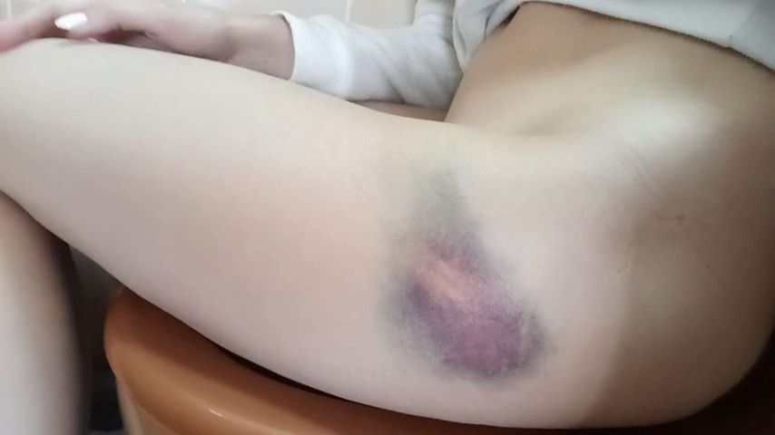 Margot pees with a big bruise on her leg