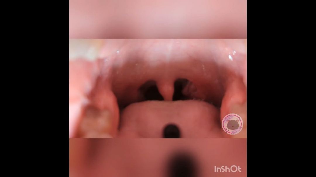 wide view of my mouth and uvula