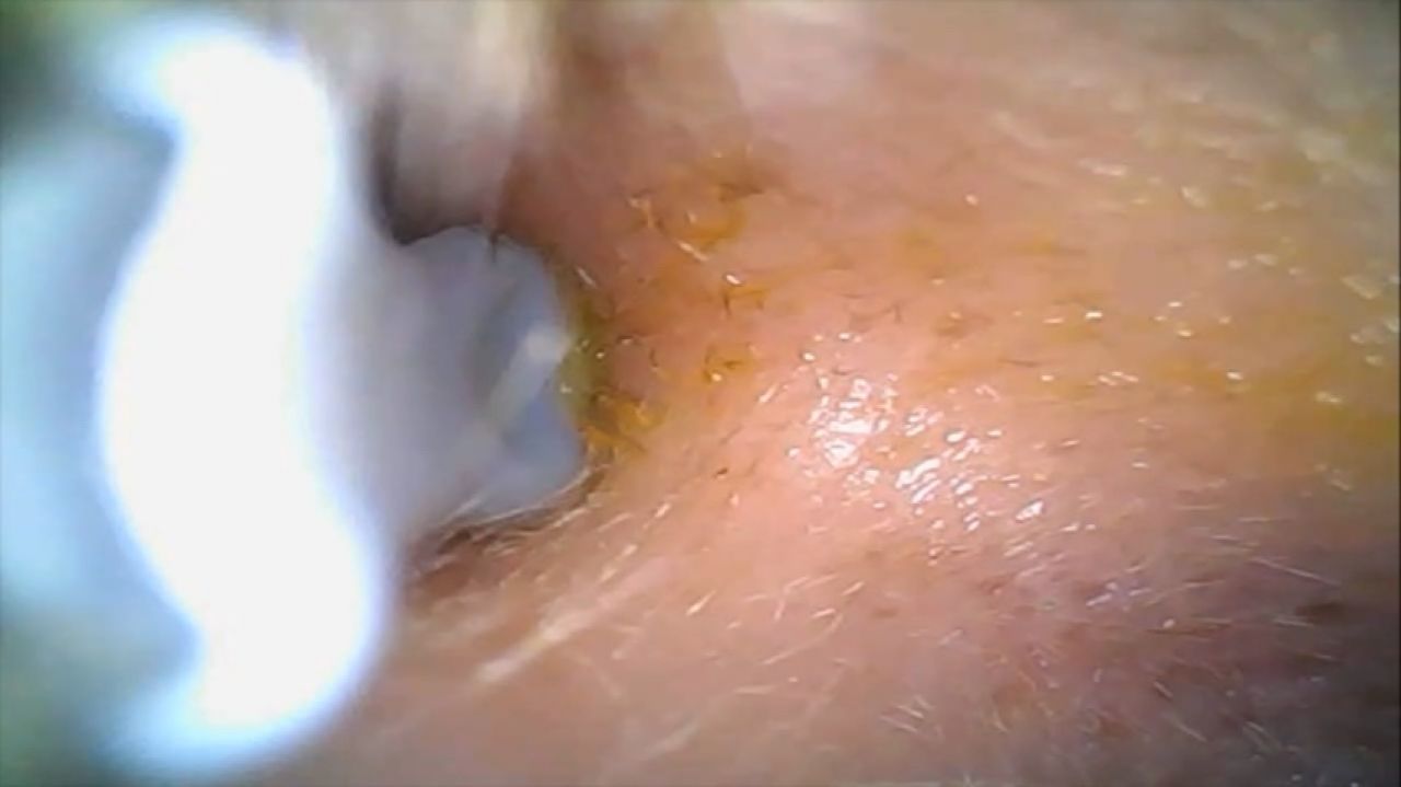 Ear Wax Cleaning 2