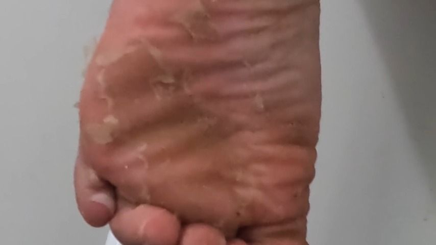 Soles peeling