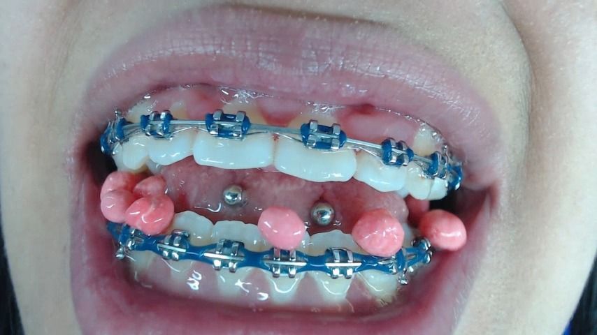 My Mouth Uvula fetish and Braces