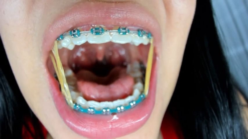 Fetish of braces and uvula