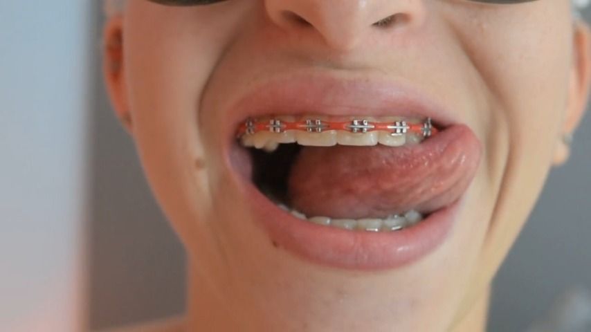 Braces