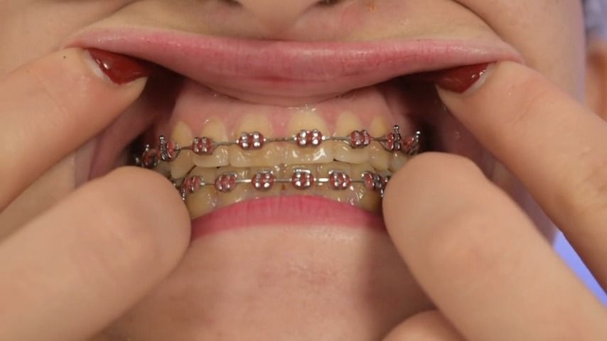 Mouth - Teeth - Braces