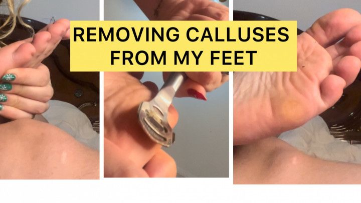 REMOVE CALLUSES FROM MY FEET