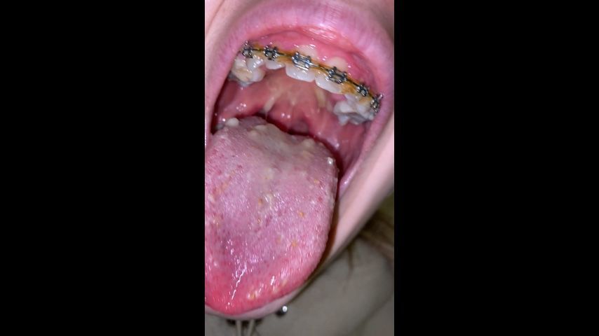 Girl with braces chewing food