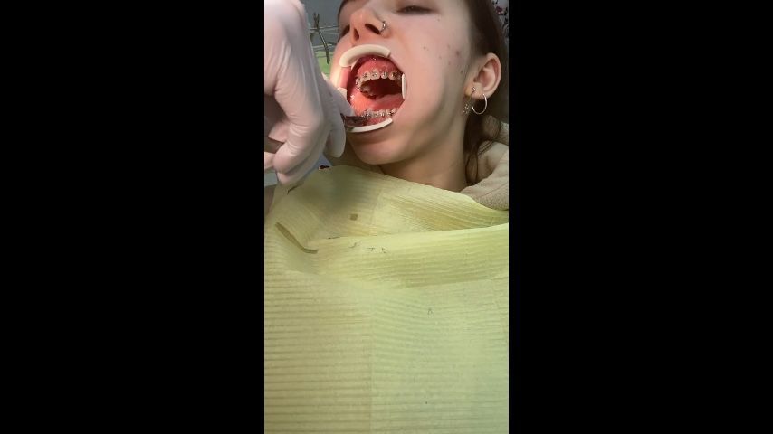 Put on Braces. Video from dentist
