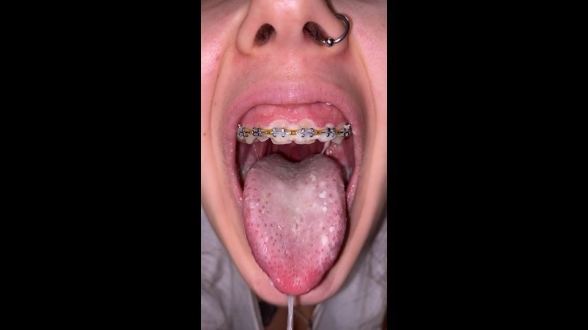 White coating in the mouth. Dirty braces