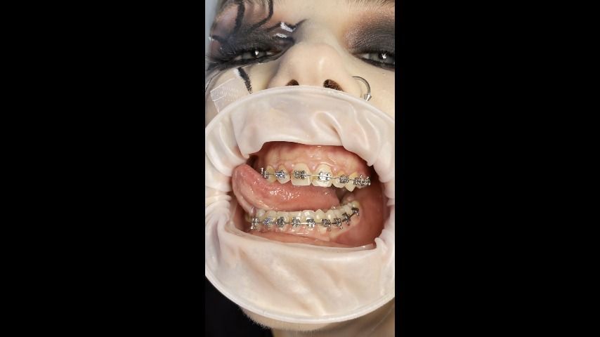 Girl with mouth expander and braces