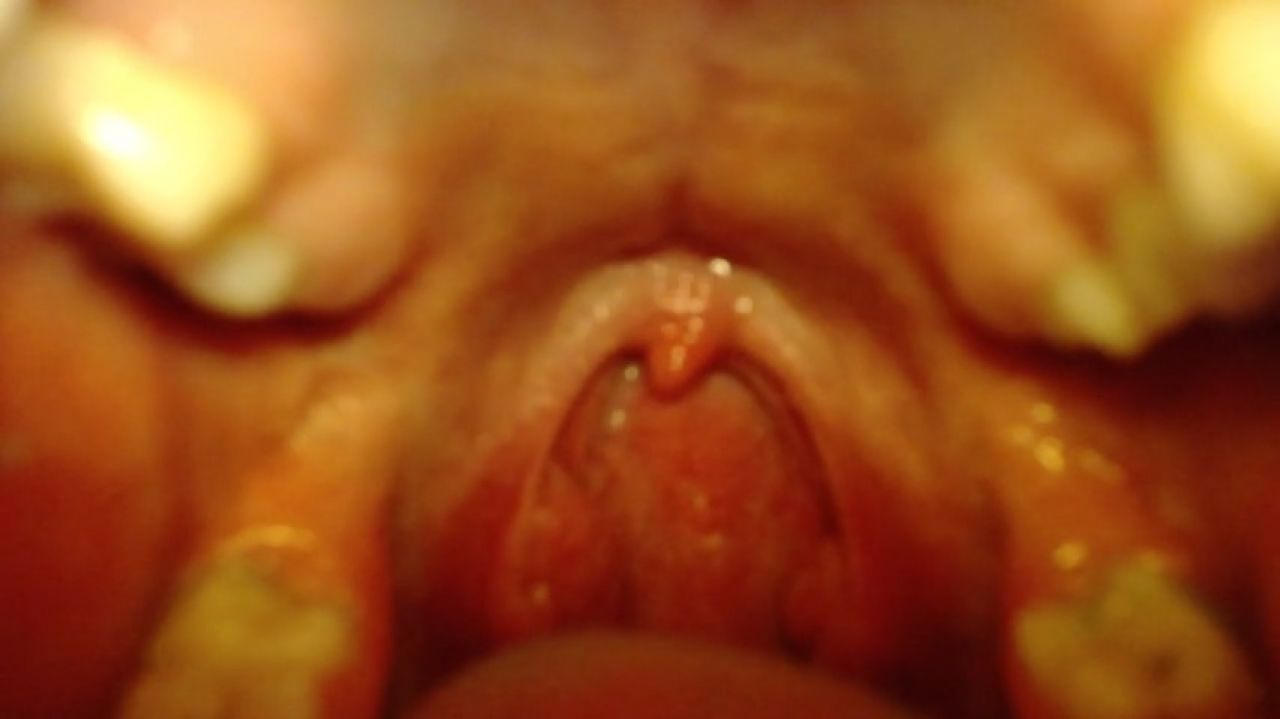 pov close uvula