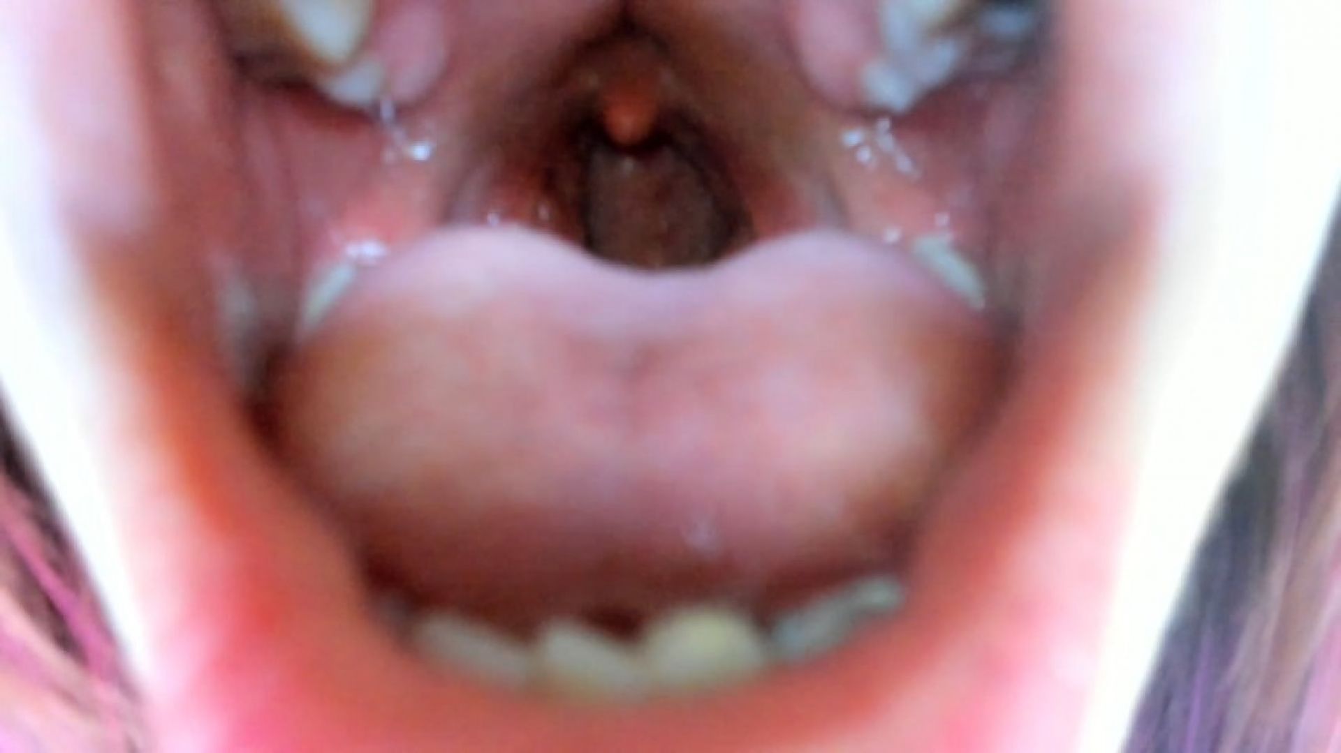 Uvula burps