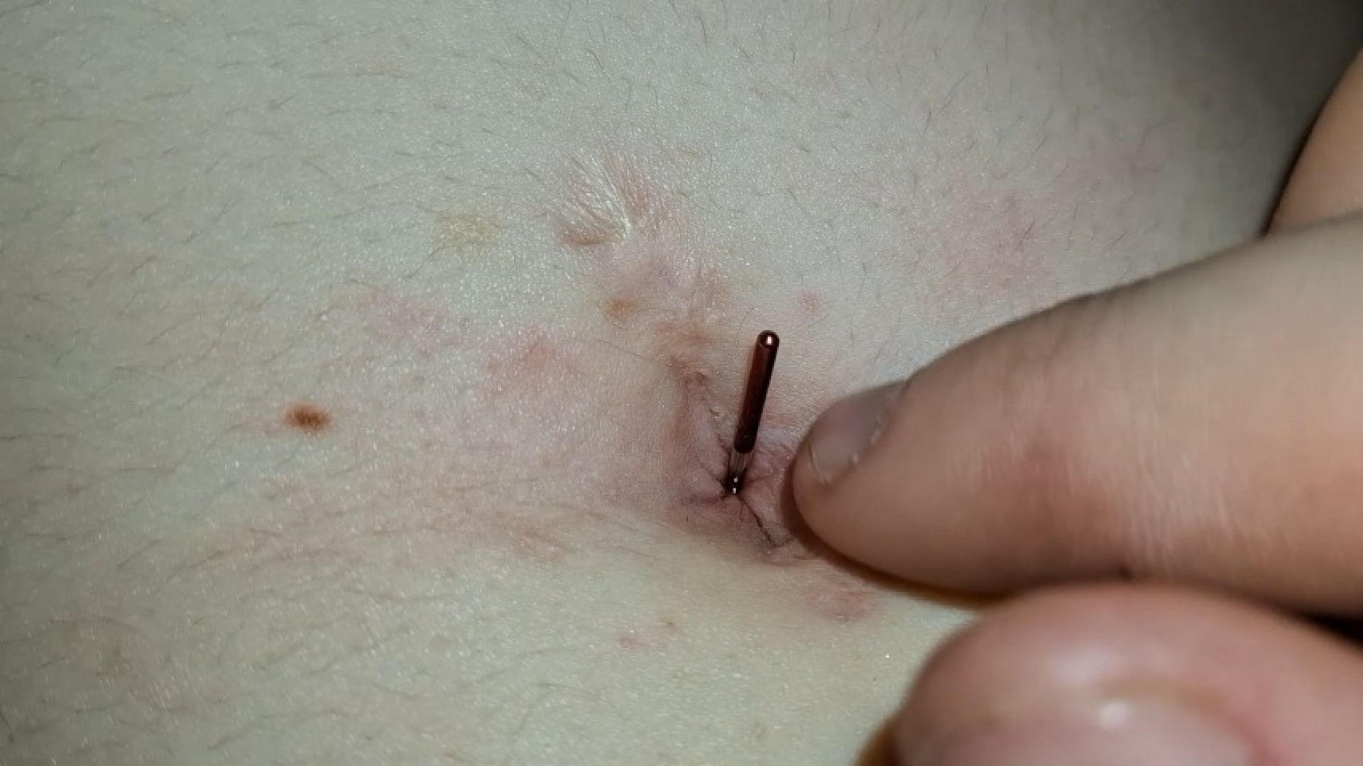 Sewing machine part in my belly button