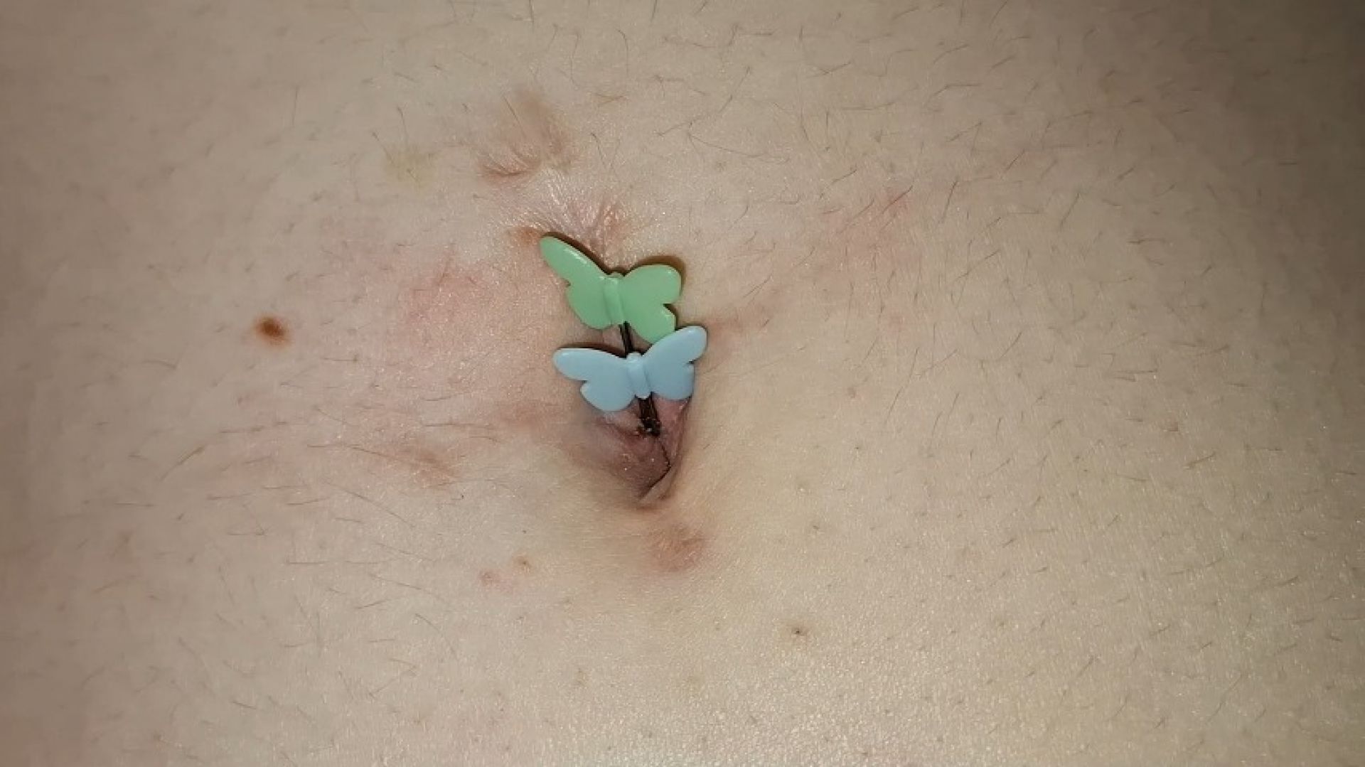 Butterfly pins in my navel