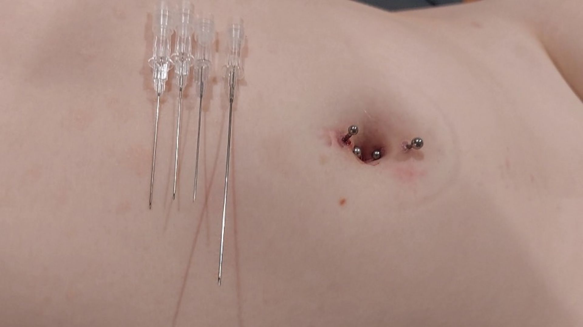 Belly button needle 6 times