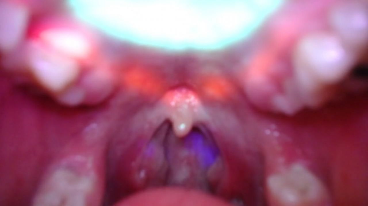 extreme colse until showing the uvula