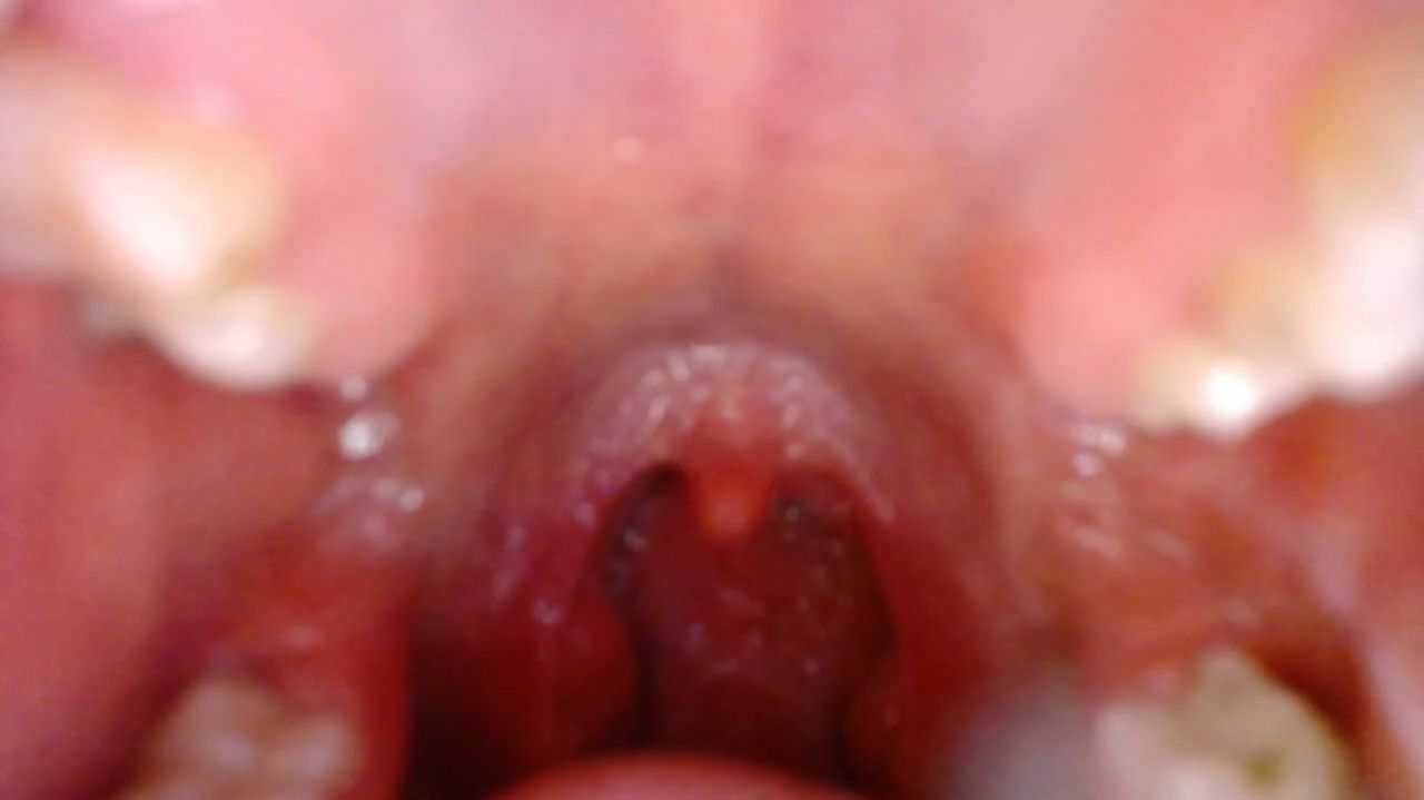 pov close uvula