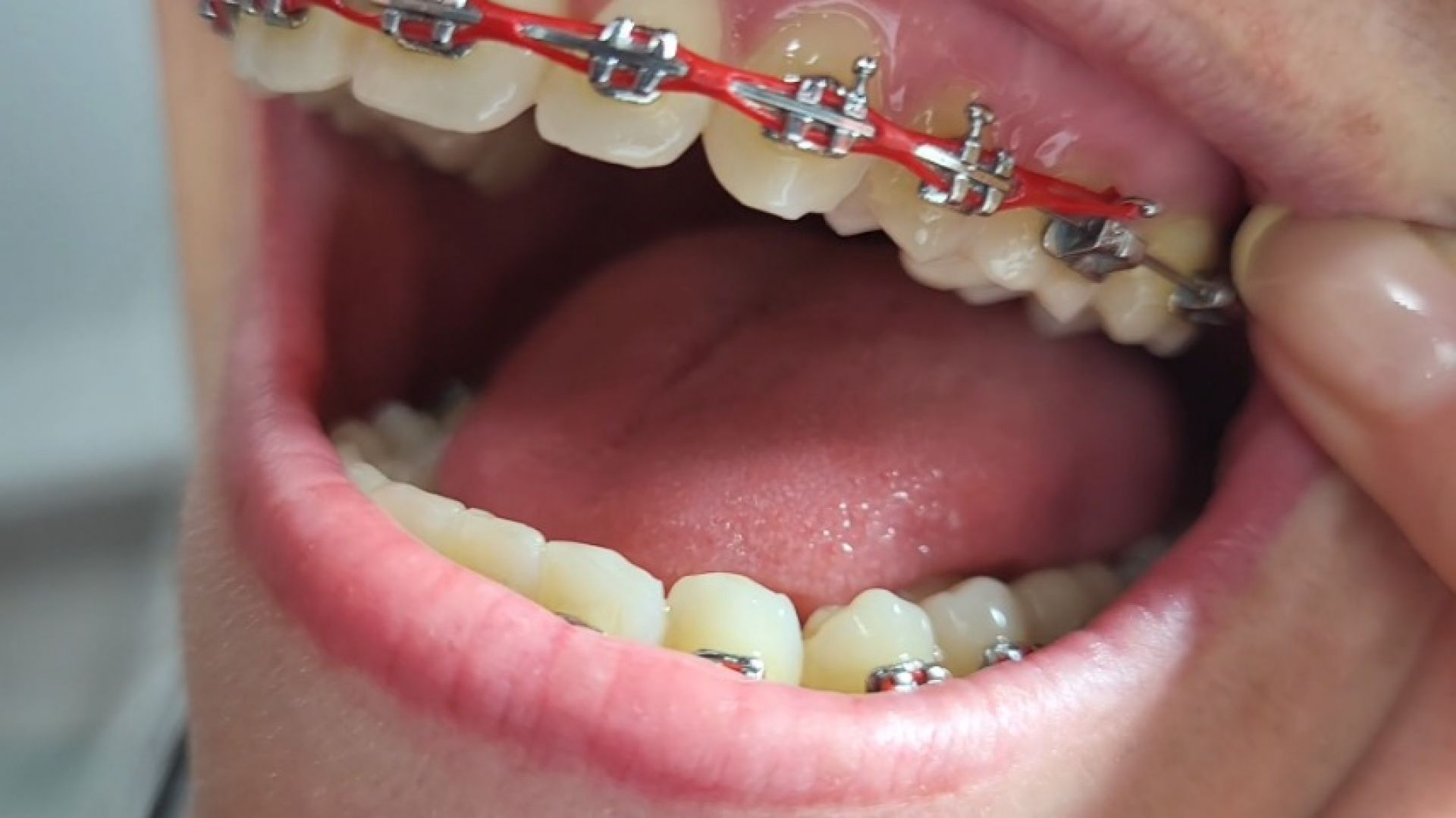 Braces and mouth with saliva fetish