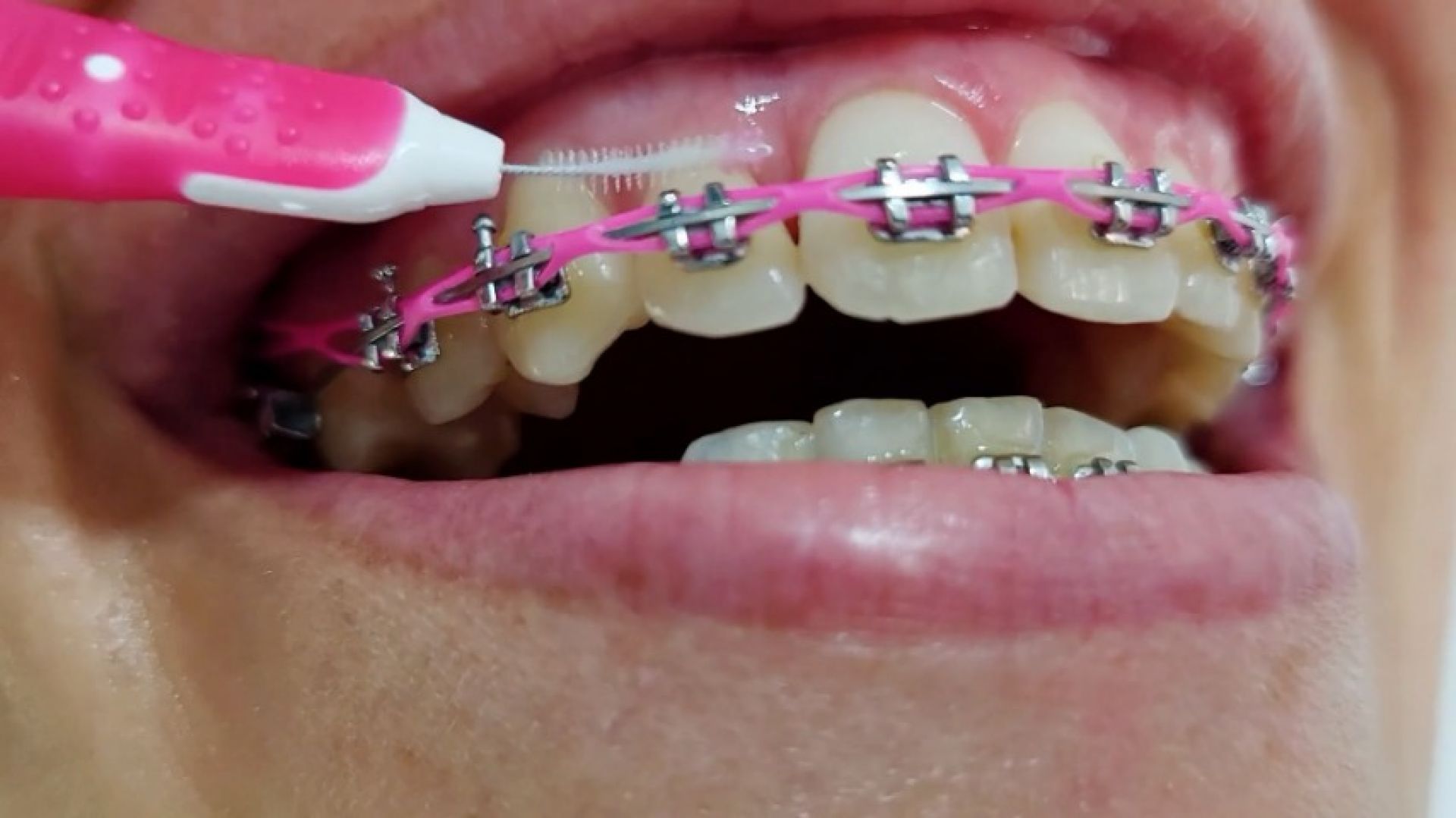 Cleaning my pink braces