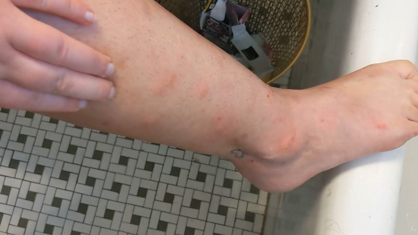 Itchy Mosquito Bites Scratching