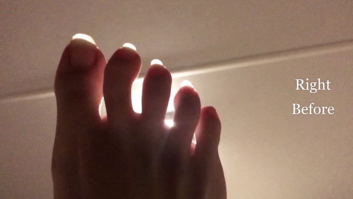 Jan 17 '23 Extremely Long Toenail Update