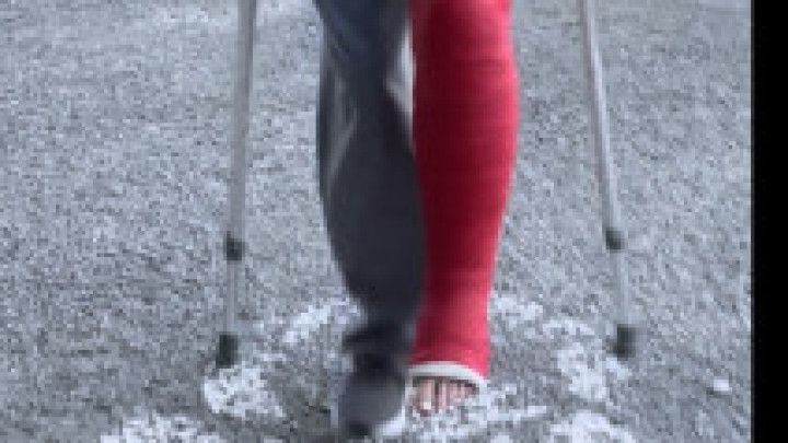 Long Leg Cast and Crutches