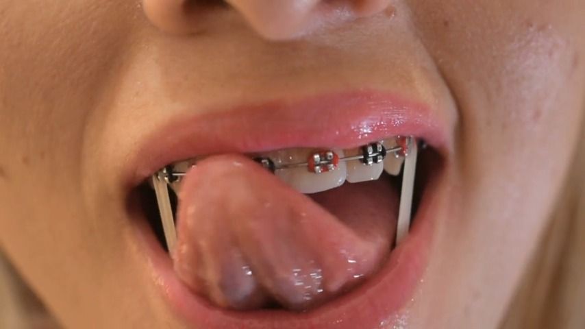 Braces and drool