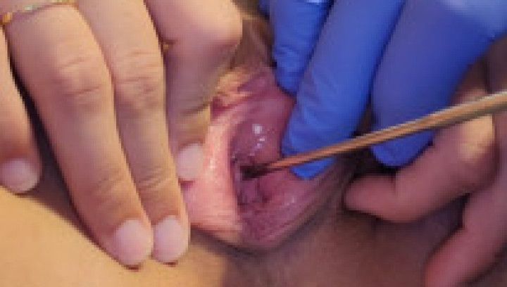 Urethra Stretching and Sounding