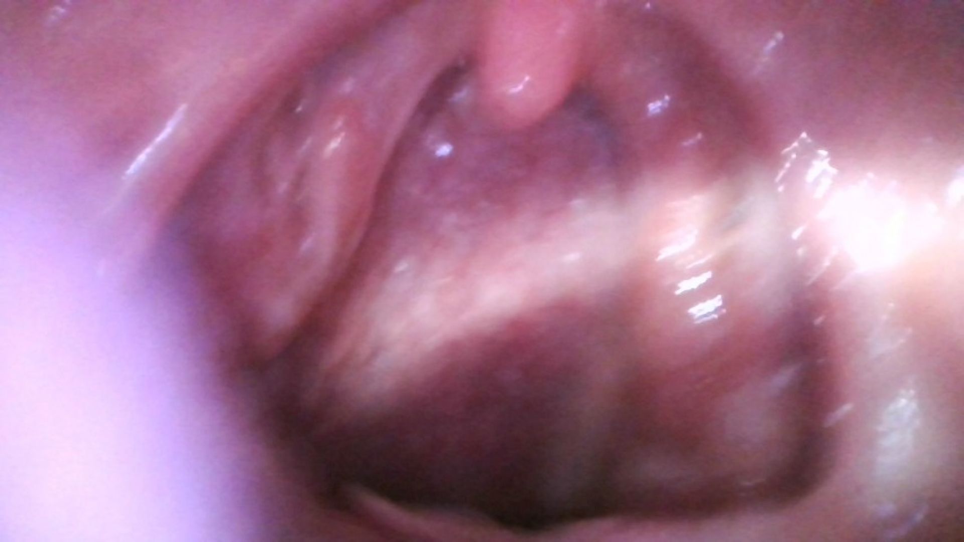 endoscope straight into my throat