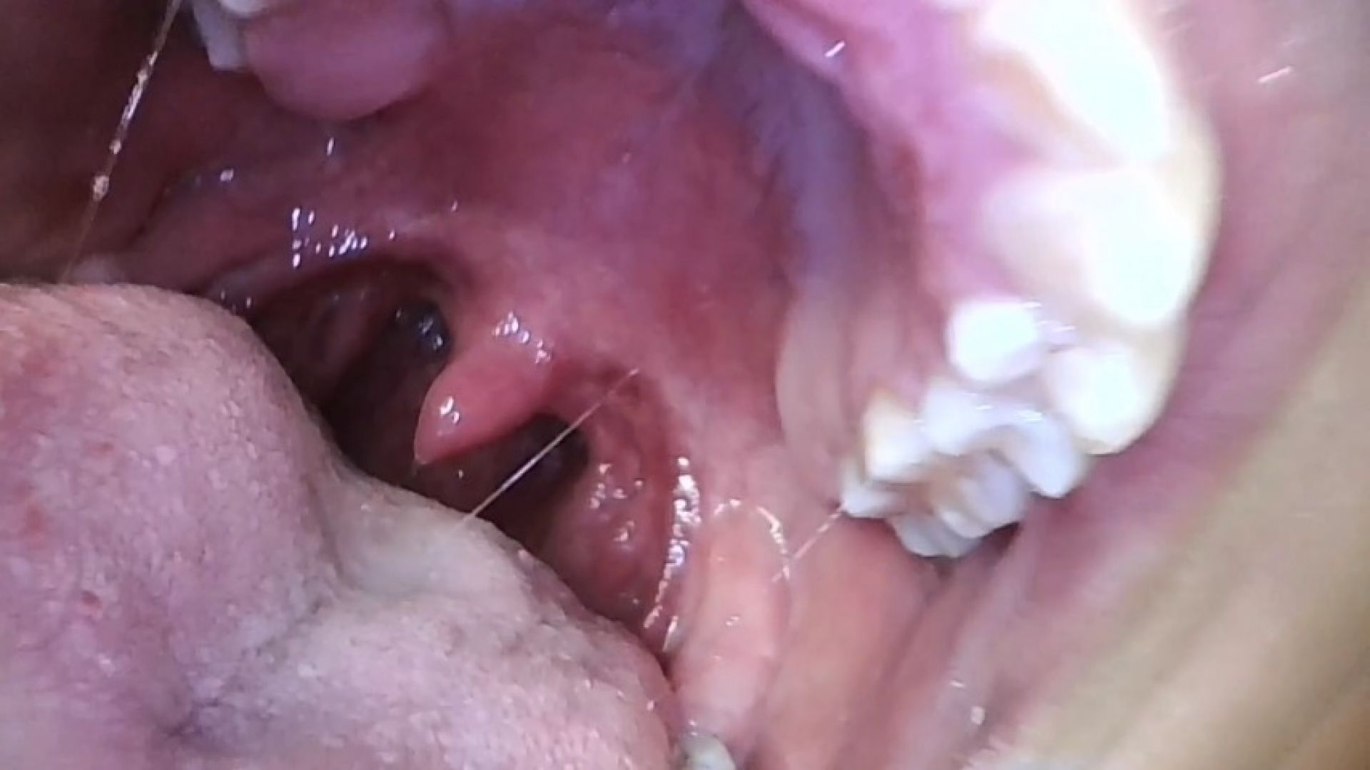 endoscope mouth deep