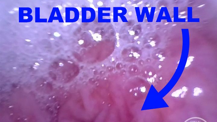 INSIDE POV: Inflating my Bladder with Air