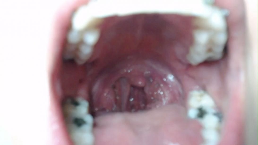 close uvula and chewing gum