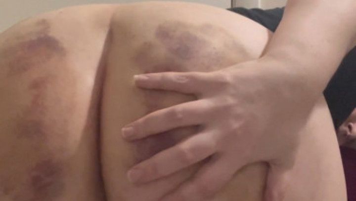 bruised booty shaking