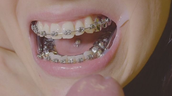 EPIC Braces HERBST and expander handjob